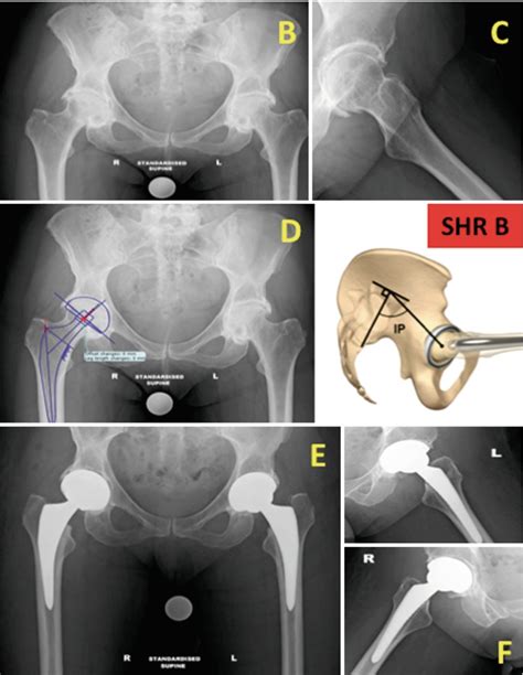 Fig 11 13 [a 62 Year Old Patient With Bilateral ] Personalized