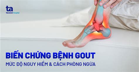 Bị Bệnh Gout Có Nguy Hiểm Không Hiểu Rõ Để Phòng Ngừa Hiệu Quả