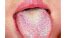 Strawberry Tongue Causes Symptoms Treatment And More