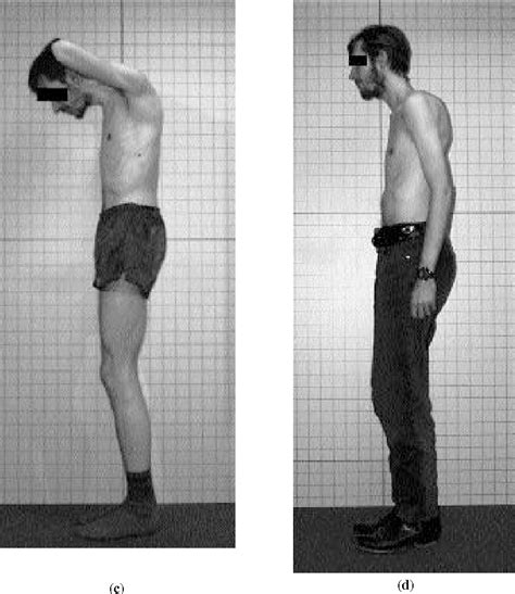 Figure 1 from Surgical options in the treatment of the spinal disorders in ankylosing ...