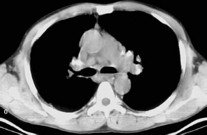 Bilateral hilar lymphadenopathy - Wikipedia