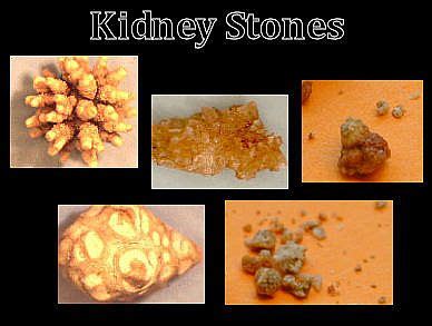 Kidney stones Causes , Predisposing factors and Types