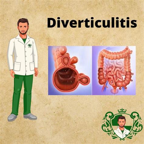 Diverticulitis Y Diverticulosis Udocz