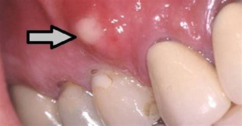 Abscessed Tooth Symptoms Causes And Treatment