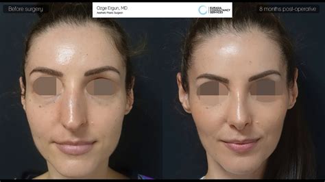 Chin Reduction Rhinoplasty Surgery Before After 8 Months Result