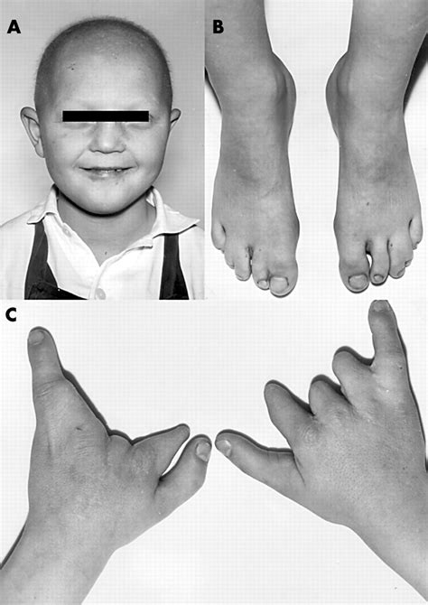 Distinct Cdh3 Mutations Cause Ectodermal Dysplasia Ectrodactyly