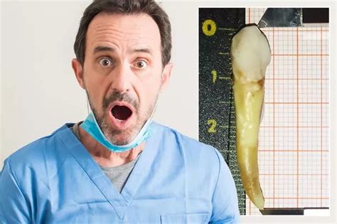 dentist stunned  extracting biggest tooth  measuring