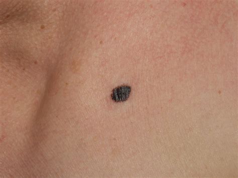 Immagini Melanoma E Tumori Della Pelle In Diversi Stadi Milano