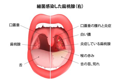 喉 痛み 白い 膿