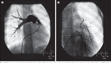 Figure 1 from High-altitude pulmonary edema in children with underlying ...