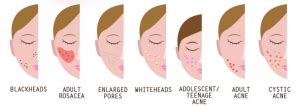 Acne Break-Outs: Causes, Symptoms, & Treatments [INFOGRAPHIC ...