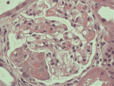 Figure 1 From Anca Associated Renal Vasculitis Following Anti Tumor