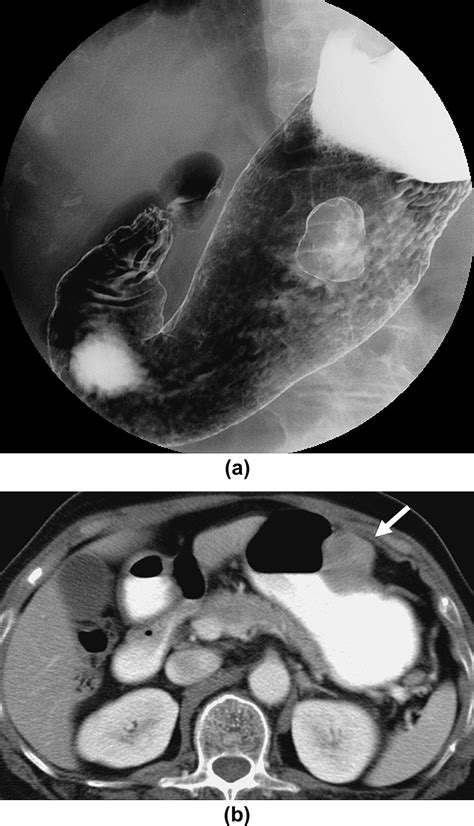 Gastric Schwannomas Radiological Features With Endoscopic And