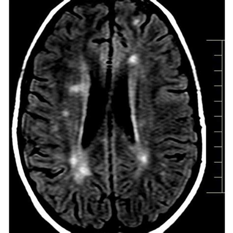 Brain Lesions Mri