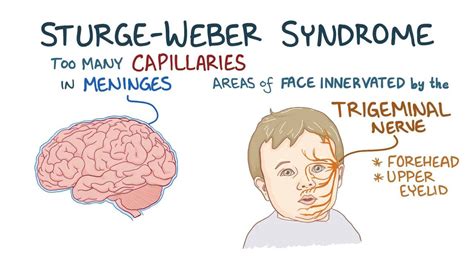 Sturge-Weber syndrome: Video, Anatomy & Definition | Osmosis