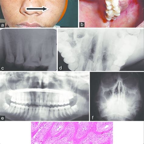 Pdf Fibrous Dysplasia Of Maxilla Report Of Two Cases