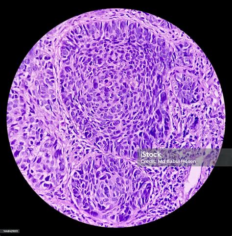 Biopsia De Tejido De La Mejilla Carcinoma Basocelular Muestra Piel