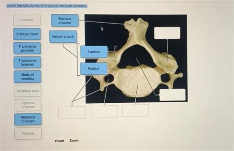 Solved Label The Structures Of A Typical Cervical Vertebra