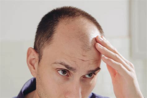 What are the Causes of a Bald Spot? | Bio Hair Clinic