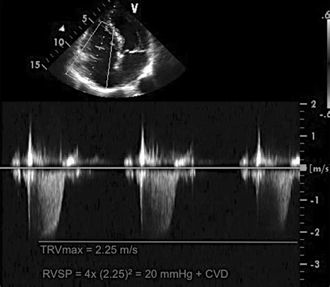 Tricuspid Regurgitation Signal This Figure Shows A Tricuspid