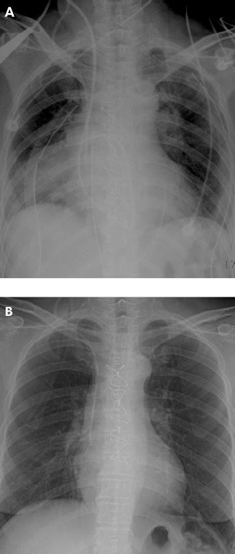 Chest Ct Scan Showing Pulmonary Thromboembolus Extending To The Right Download Scientific