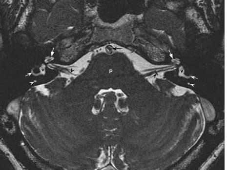 Vestibular Nerve Mri