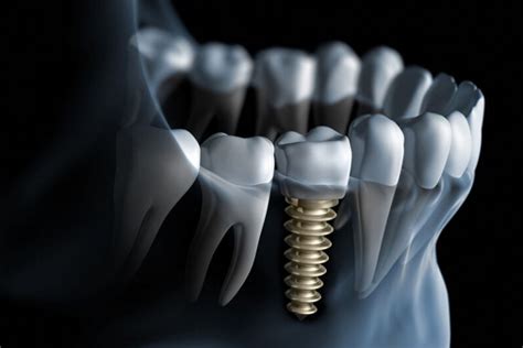 Dental Implants Plano TX | Implant Dentistry | Bass and Hall Dental ...