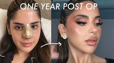 Year Post Op Nose Job Update Q A Youtube