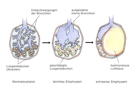 COPD Chronisch Obstruktive Lungenerkrankung Eesom Gesundheitsportal