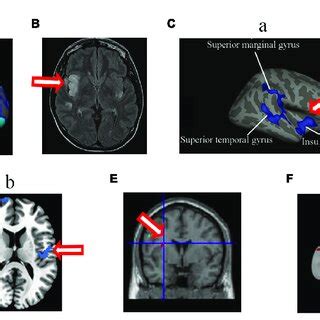 Changed structure and function in insular cortex in HA population. (A)... | Download Scientific ...