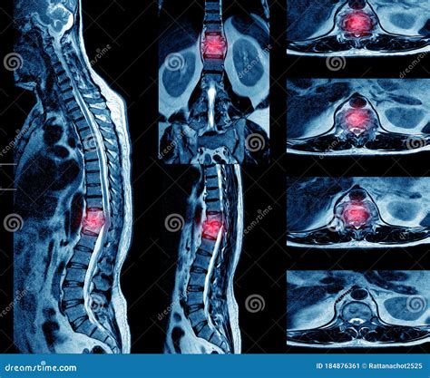 MRI OF THE THORACIC SPINE HISTORY: A 62-year-old Male With Suspected TB ...