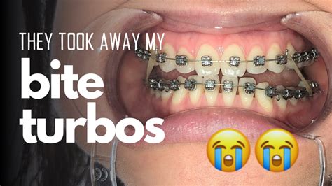 Bite Turbos And Elastics Adult Braces Update Vlog Youtube