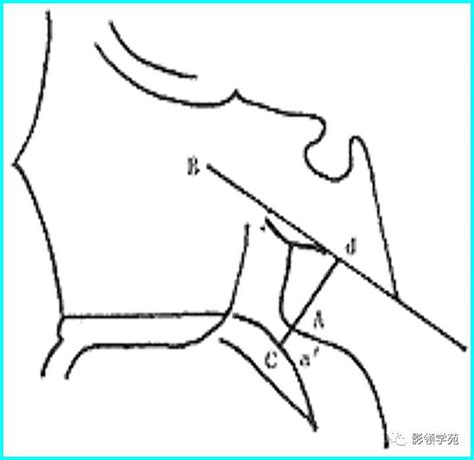 儿童腺样体肥大影像表现及诊断标准手机搜狐网