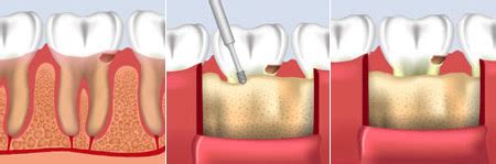 Surgical crown lengthening – DentalCenter