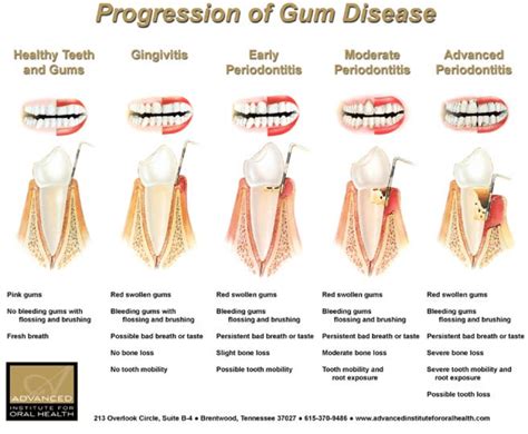 Gum Disease Thirtytwo Dental