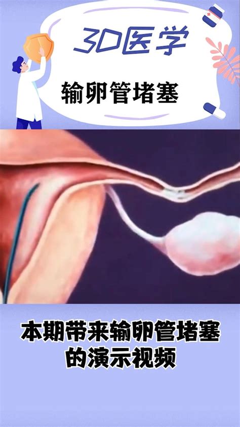 输卵管堵塞的过程，用3d动画来告诉你腾讯视频