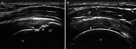 Fig 16 1 Supraspinatus Tear Articular Side Partial Thickness