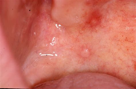 Soft Palate Mouth Cancer