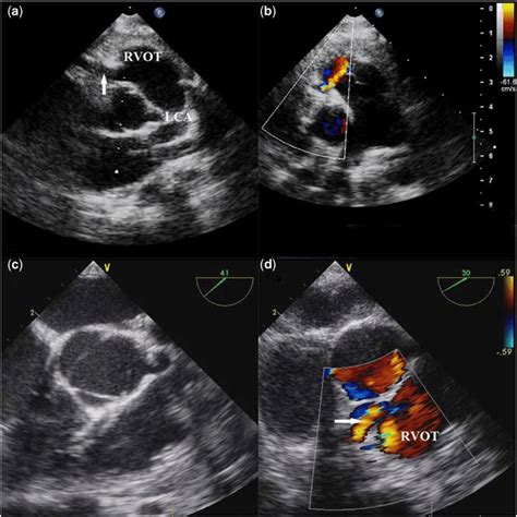 Ab Transthoracic Echocardiography Prominent And Dilated Left