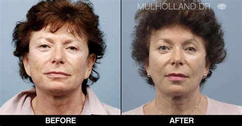 Cheek Lift Surgery (Mid-Facelift) | Toronto Plastic Surgeons