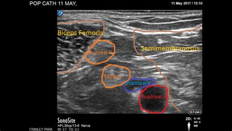 Sciatic Nerve Block Ultrasound