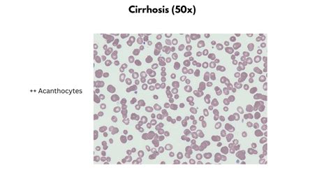 Macrocytic Anemias The Blood Project