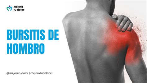 Bursitis De Hombro Te Explicamos Qu Es Este Dolor Cr Nico