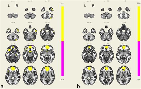 Occipital lobe | PLOS ONE