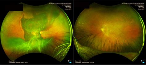 OPTOS Ultra-widefield Imaging - Northern Sydney Cataract