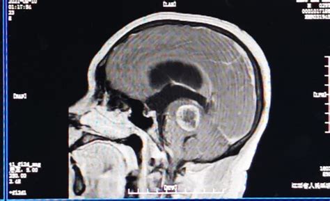 一例脑干胶质瘤显微手术治疗 脑医汇 神外资讯 神介资讯
