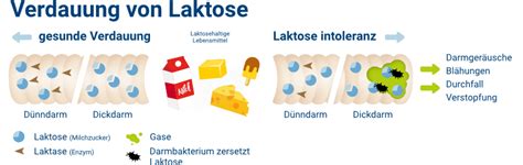 Laktoseintoleranz Ursachen Symptome Und Behandlung