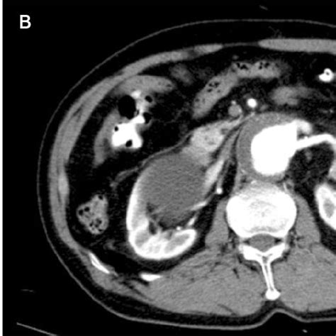 Preoperative Abdominal Computed Tomography Ct Angiography Scan