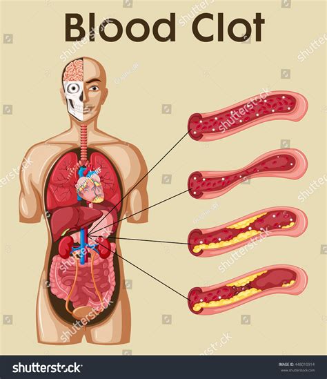Blood clot clip art