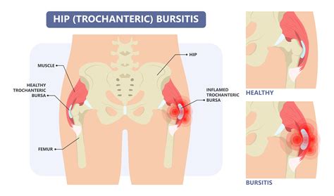 Trochanteric Bursitis | Florida Joint Care Institute | Trinity, FL